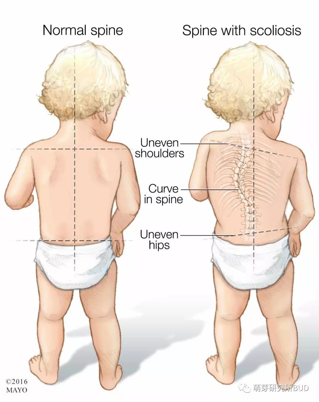 儿童背部正常脊柱图片图片