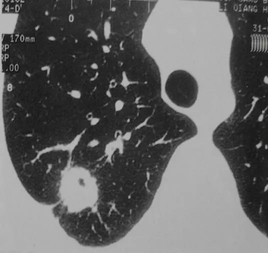 周围型肺癌ct表现图片图片