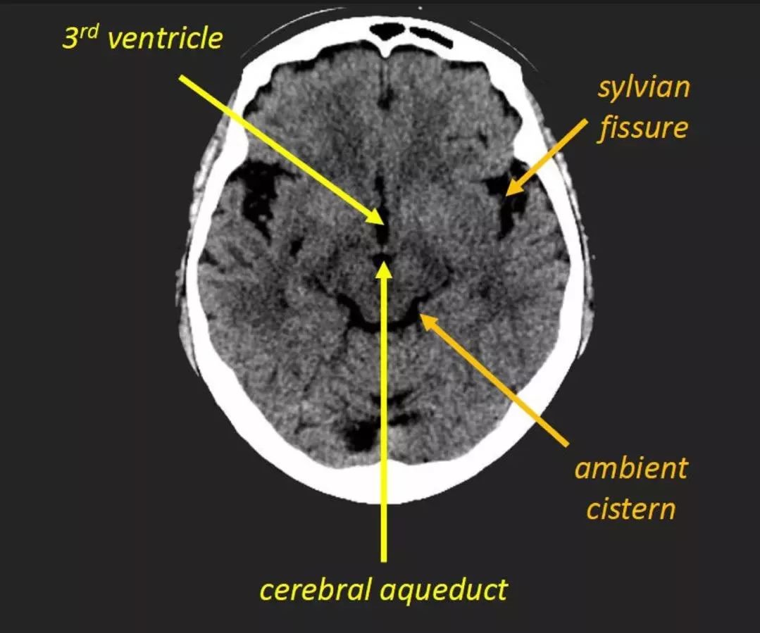 sylvian fissure:大脑外侧裂anterior horn of lateral ventricles:侧