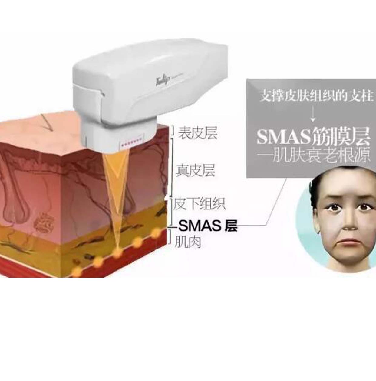 超声刀美容原理超声刀美容有副作用嘛值得收藏