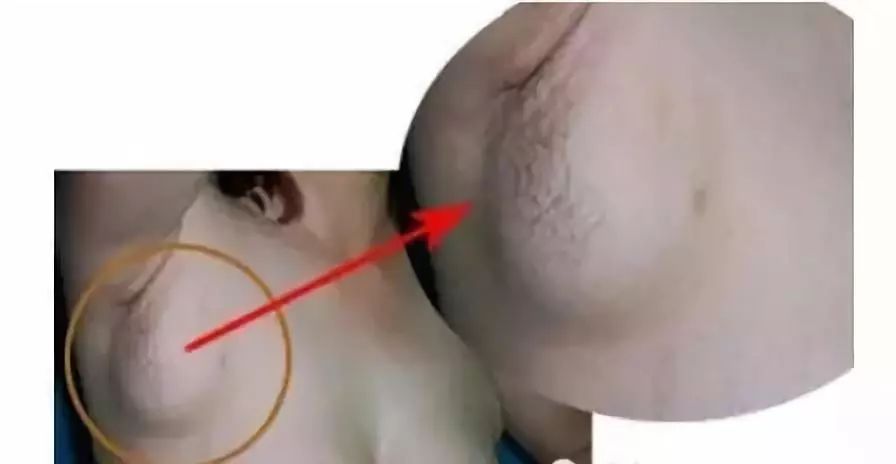 腋下淋巴结的位置图片图片