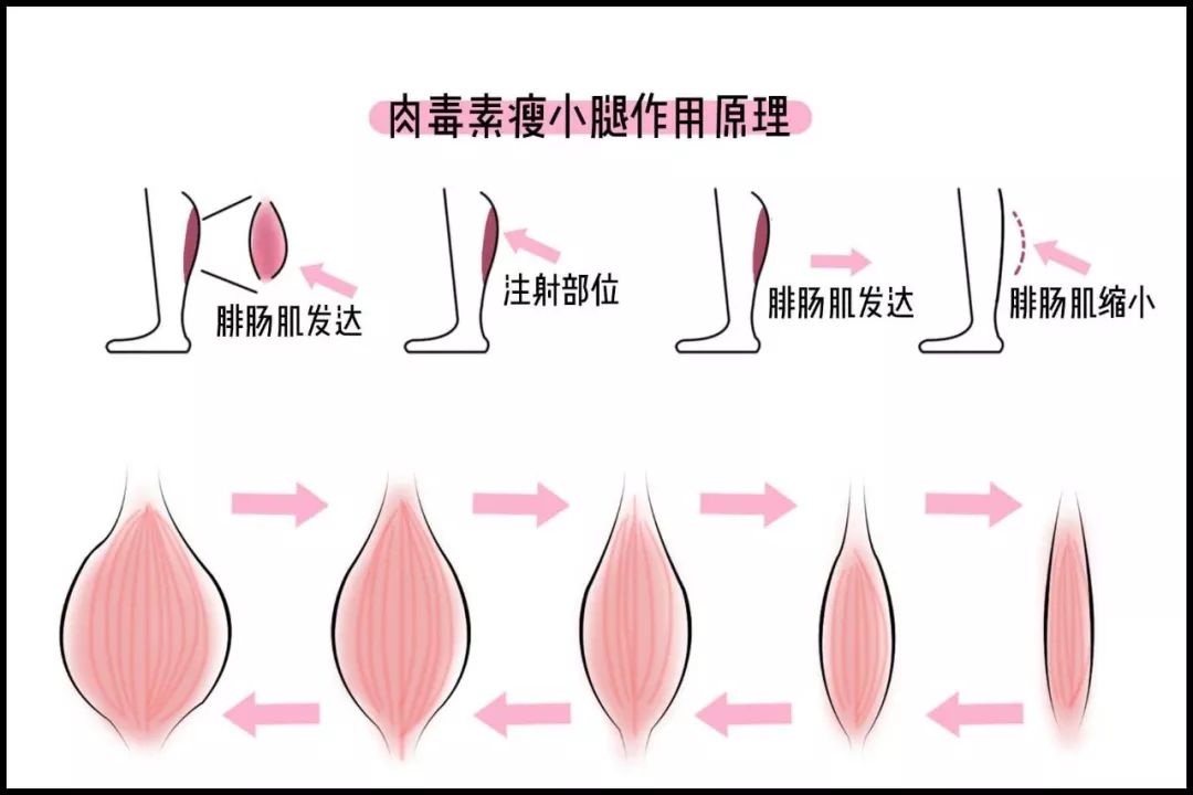 a型肉毒素(bont-a)属于 处方药,还被纳