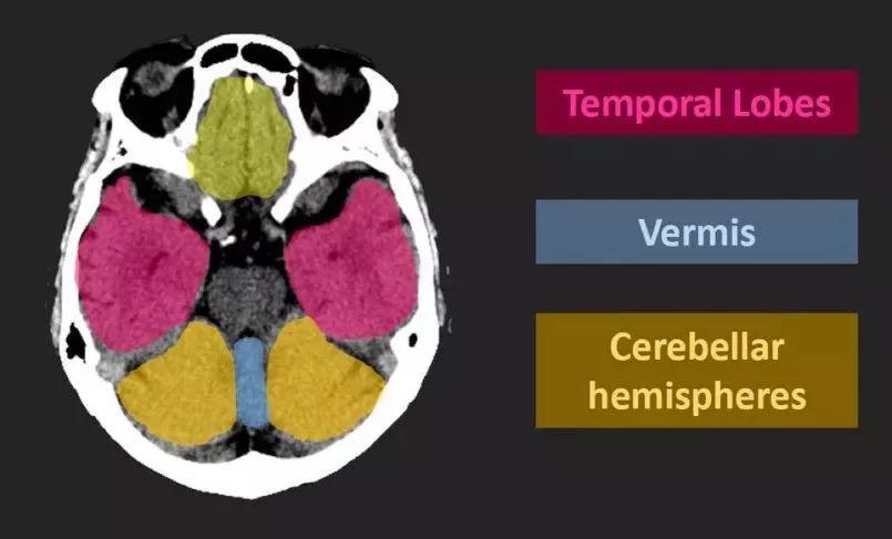 temporal [04temp05r05l] lobe:颞叶vermis [v08:m01s] n.