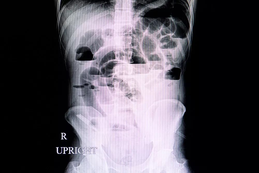 肠梗阻x线气液平面图图片