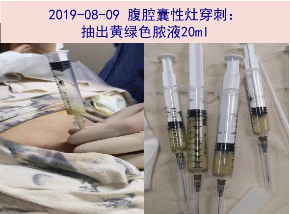 探案:发热,腹腔占位,血性腹水——熟悉的病因,陌生的表现