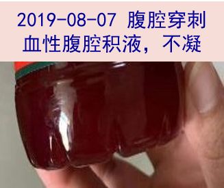 探案:发热,腹腔占位,血性腹水——熟悉的病因,陌生的表现