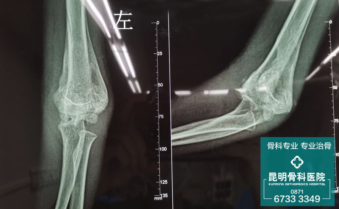 5岁孩子骨折包草药两月后肘关节变畸形