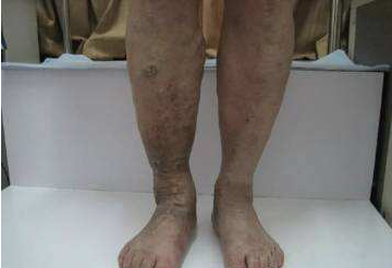 练腿的姿势不对,静脉曲张加重练腿对于静脉曲张的朋友来说非常的重要