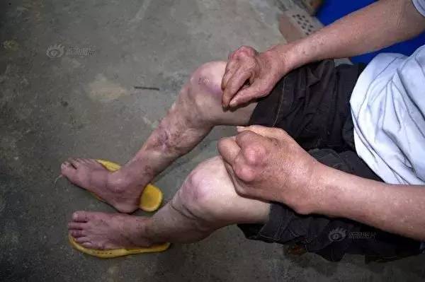 镇被誉为全球电子垃圾之都镇上80%孩子都患有铅中毒病河南省沈丘的东