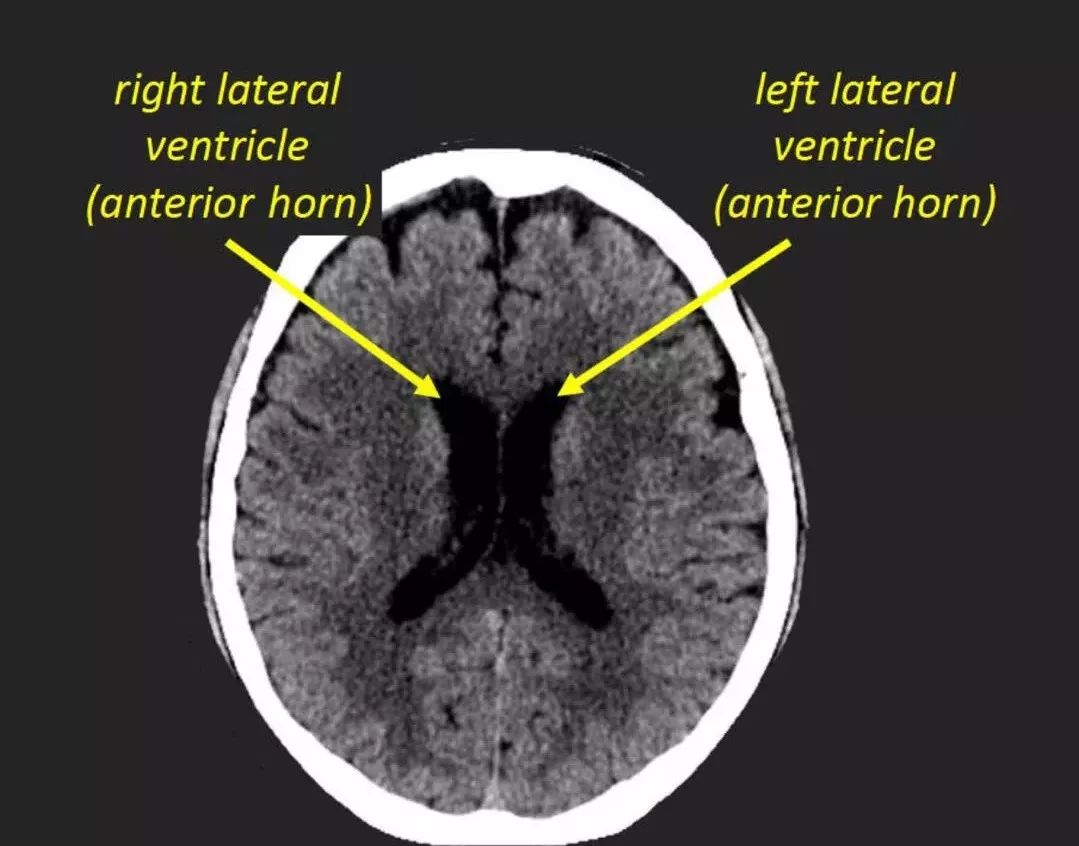 头颅CT提示透明隔增宽图片