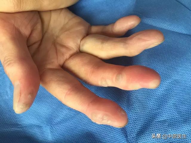 60岁老人右手拇指长一黄豆大小皮色丘疹,有人说1000天才能好