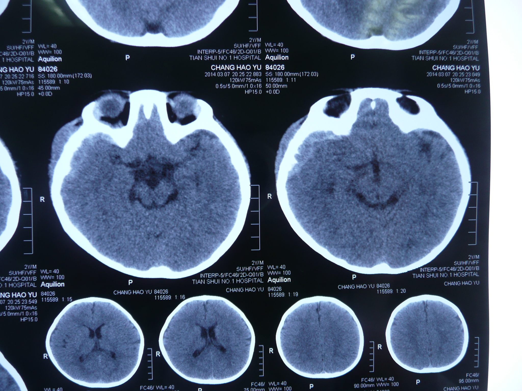 放療:放療對於特殊部位朗格漢斯細胞增生症效果較好,需注意防止放療後