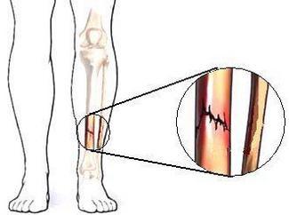 骨折和骨裂区别在哪哪个更严重都要手术吗专家教你3点区分