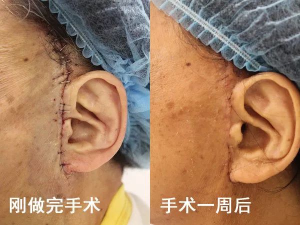 fda认证皱纹消消乐单次5w减十岁搭配它才最有效