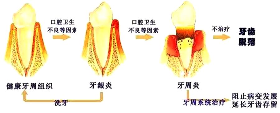 當牙髓炎進一步發展成根尖周炎,即牙齒根尖部牙周膜和骨組織的炎症