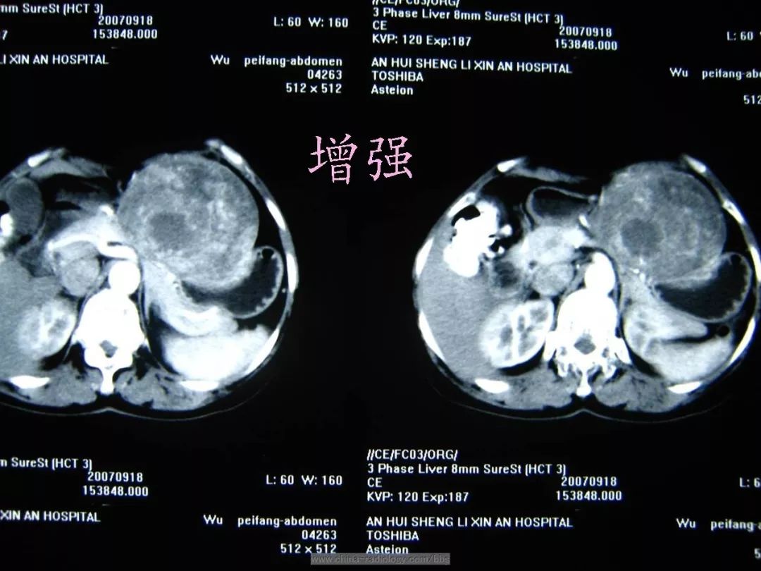 胃間質瘤等你分析丨讀片專欄1178期