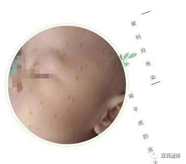 婴儿脸上扁平疣图片图片