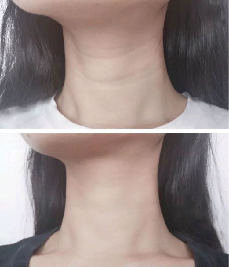 别让颈纹出卖你的年龄火爆网红界的去颈纹神器一分钟双手按摩60次28天