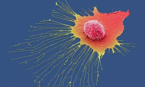 研究发现乳腺癌细胞可以进入睡眠模式并在未来复发