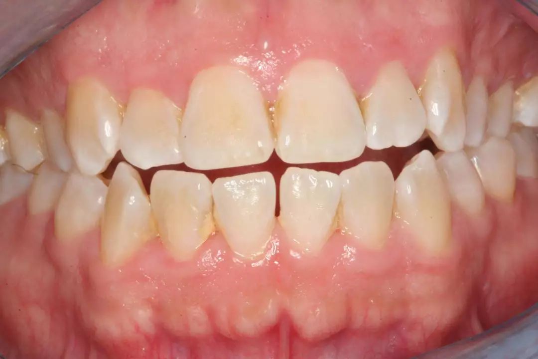 晚期牙龈疾病如果不予治疗,牙龈炎会导致更严重的感染,称为牙周炎