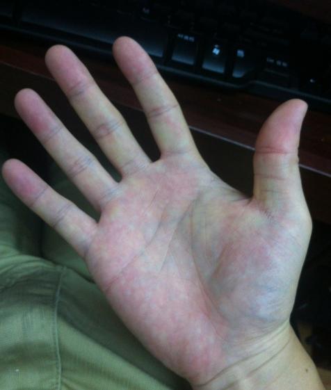 2,手掌异常若肝脏消耗过度,熬夜过多,指甲会开始变得粗糙,且出现很多