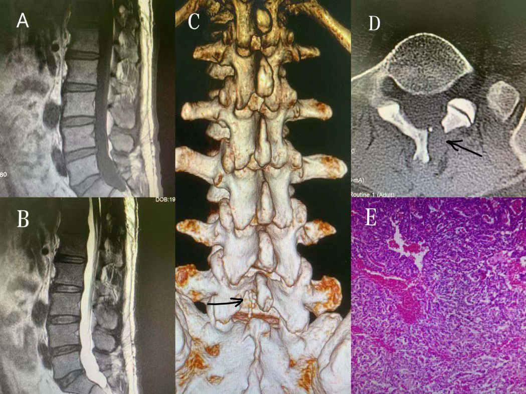 表现为颅高压症状的腰椎管内副神经节瘤一例(脊柱脊髓系列九)---浙二