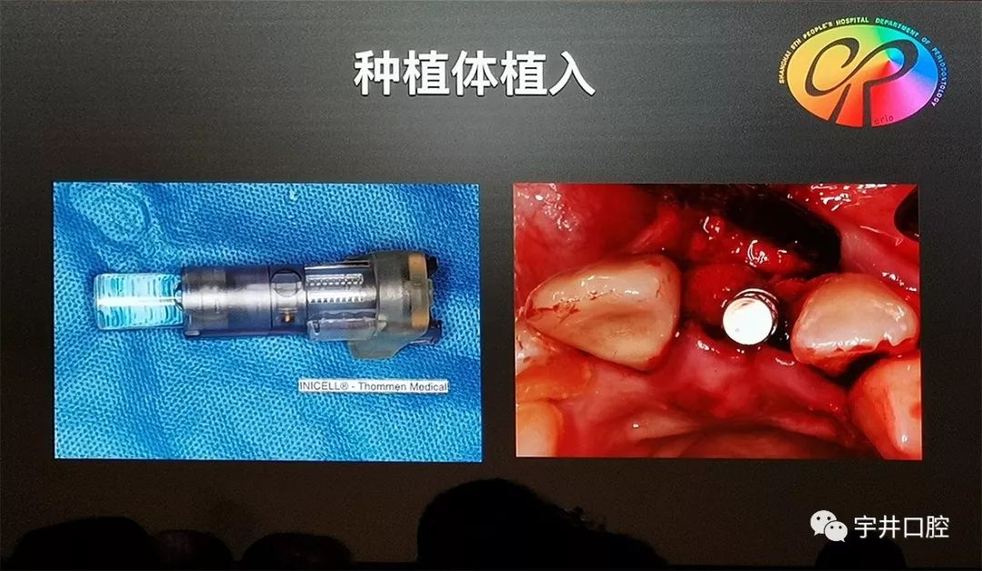 祝贺林智恺医生荣获第八次bitc口腔种植大奖赛暨青年学者论坛苏州站三