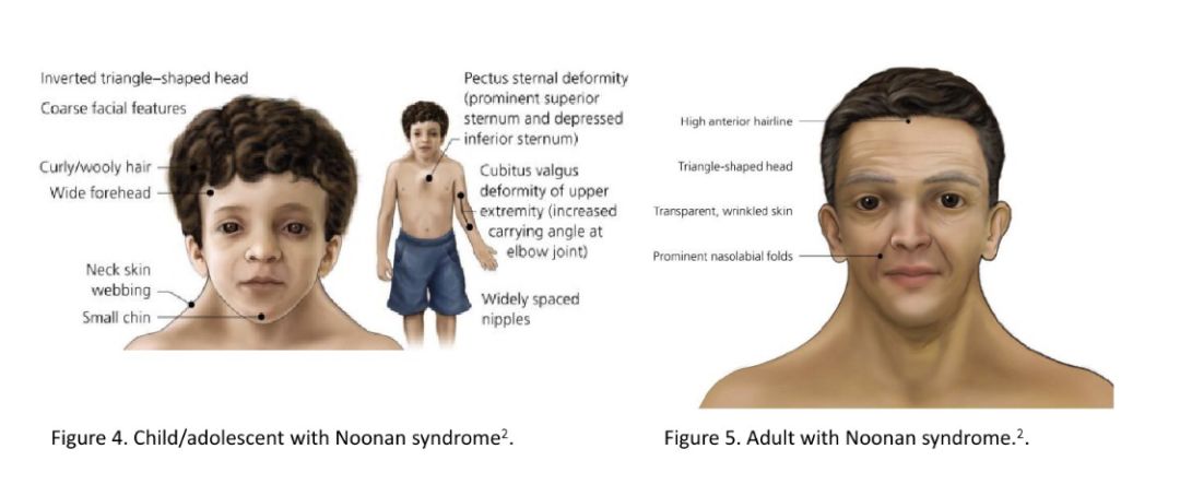 努南综合征胎儿的特点图片