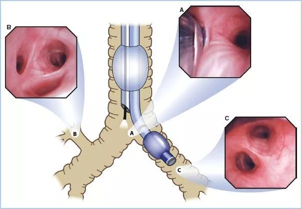 如何做好雙腔支氣管插管這裡有最詳細的教程