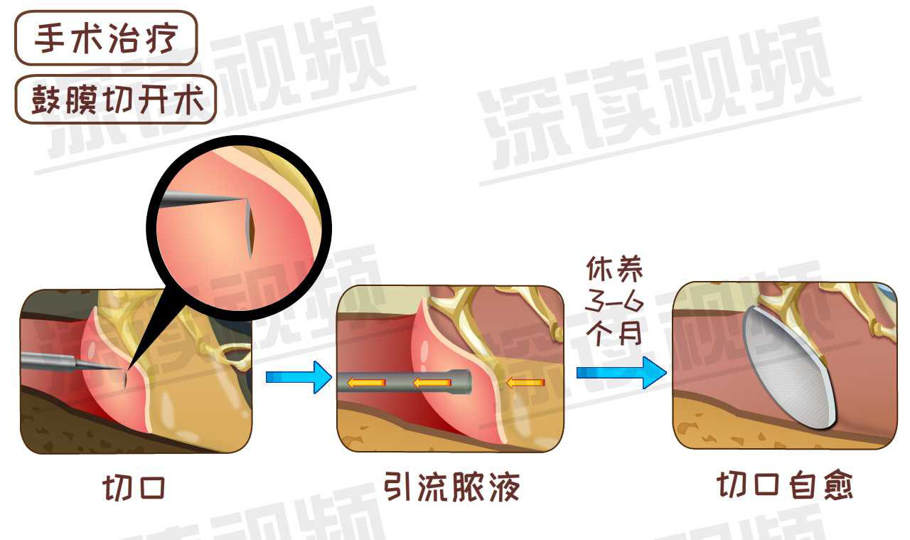 鼓膜置管手术图片