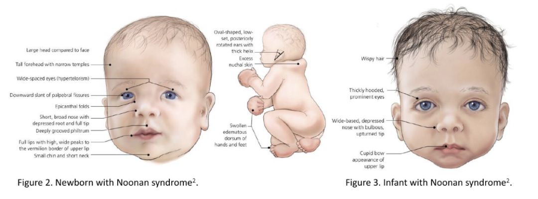 努南综合征胎儿的特点图片