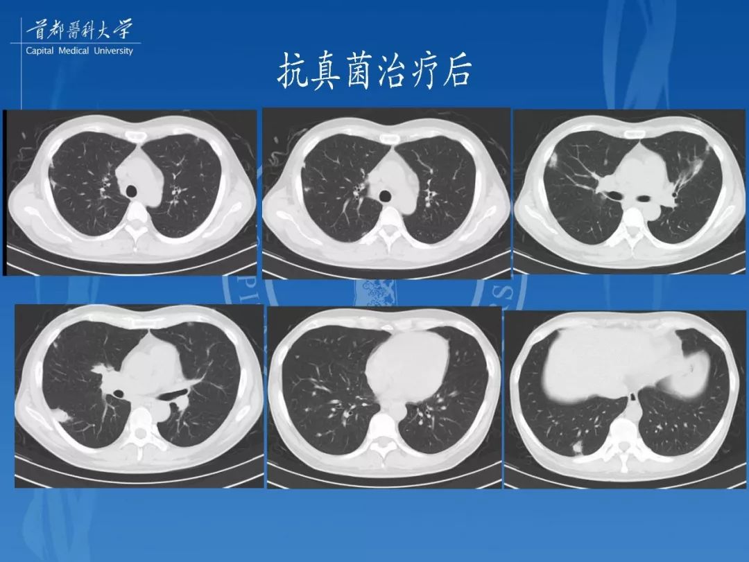 结核性肉芽肿结节的影像特点和鉴别诊断