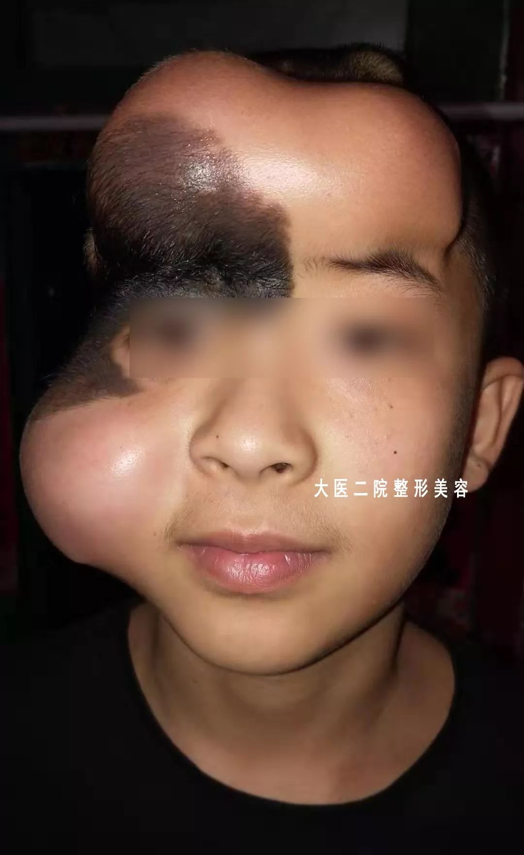 经过赵主任的诊治,最后决定使用皮肤软组织扩张器的方法,扩充周围正常