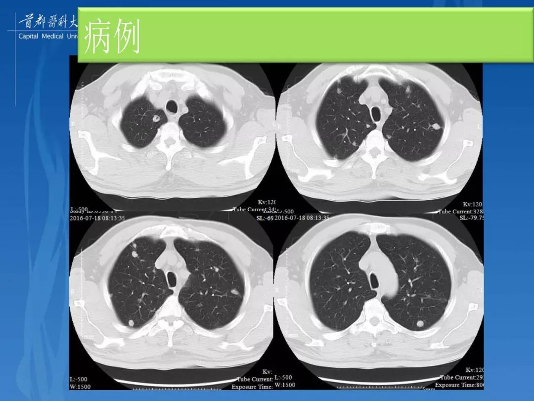 结核性肉芽肿结节的影像特点和鉴别诊断