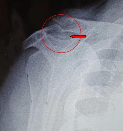 肩胛骨侧位x线图片