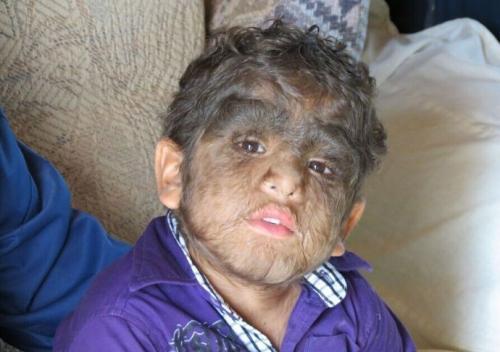 西班牙数十名儿童服错药物患上狼人综合症体毛过度生长