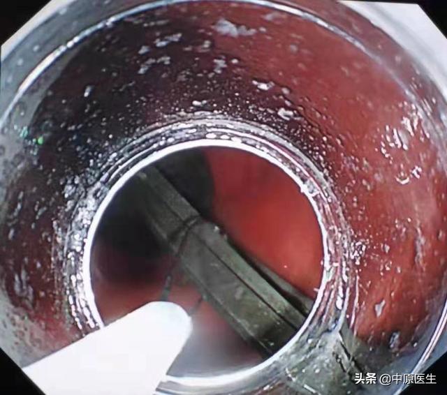 临床案例女子喝醉酒把三把汤匙吞到胃里幸亏医生经验丰富