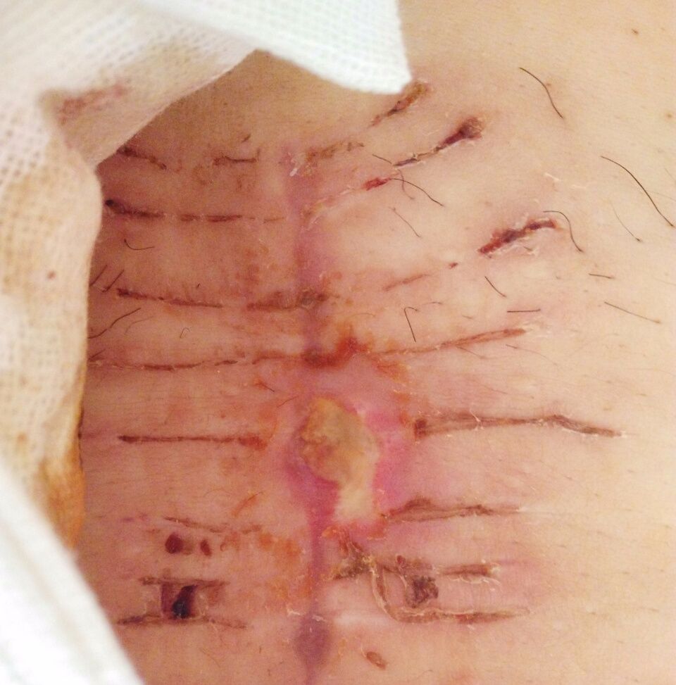 破腹产疤痕纹身图案图片