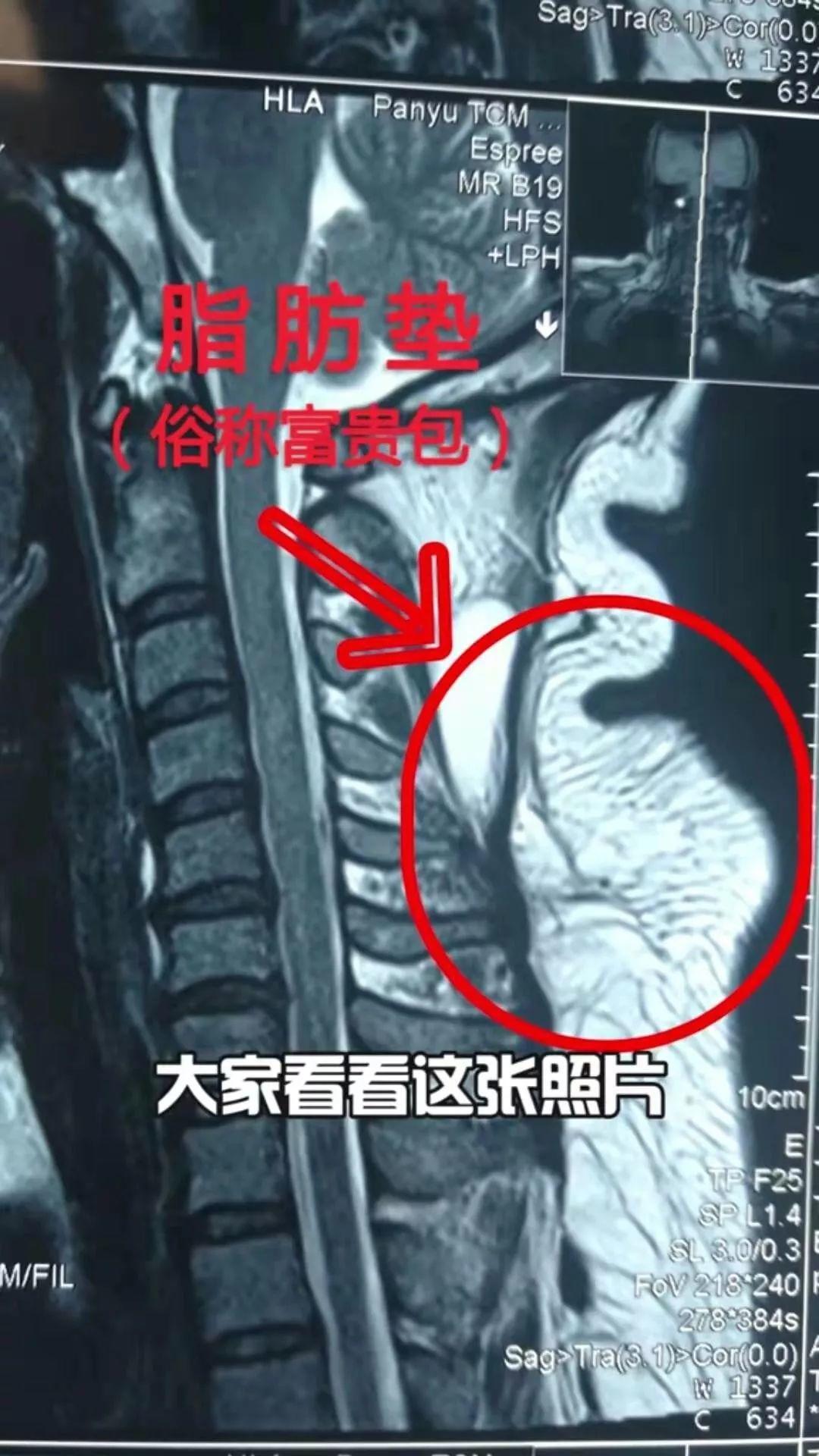 富贵包是夺命包吗