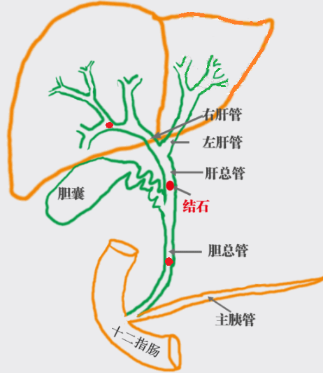 肝内胆管结石位置图图片