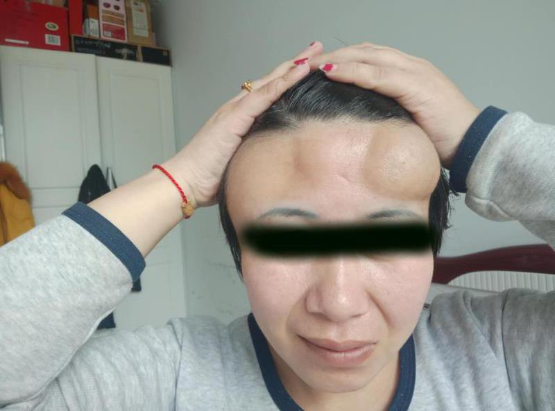 颅骨缺损致前额俩深坑,航空总医院穆苍山用peek完美修复