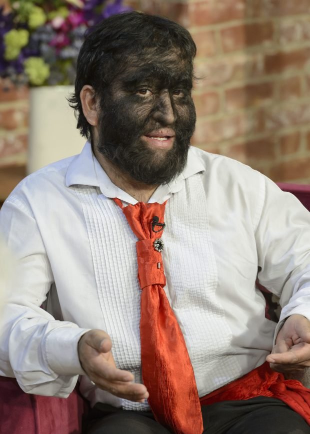 西班牙数十名儿童服错药物患上狼人综合症体毛过度生长