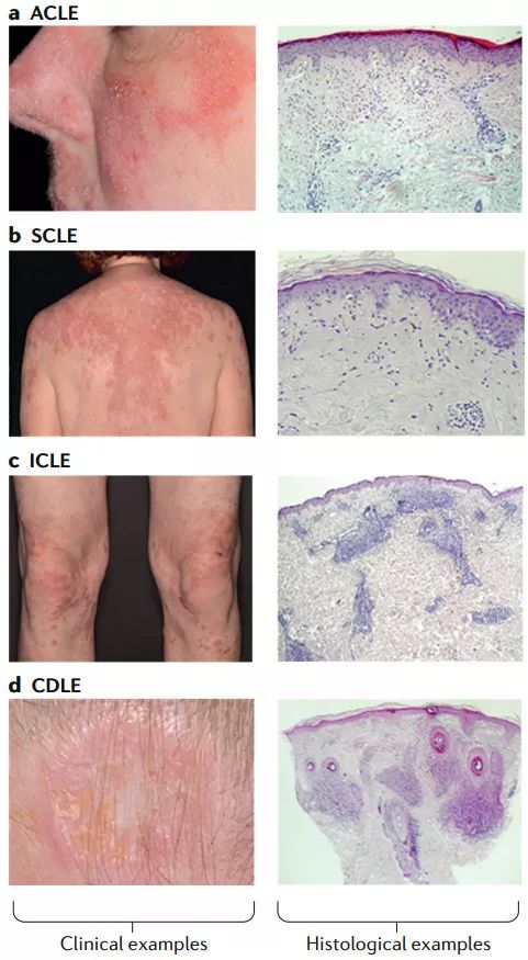 nature綜述 | 皮膚型紅斑狼瘡發病機制及9類新療法最全解析