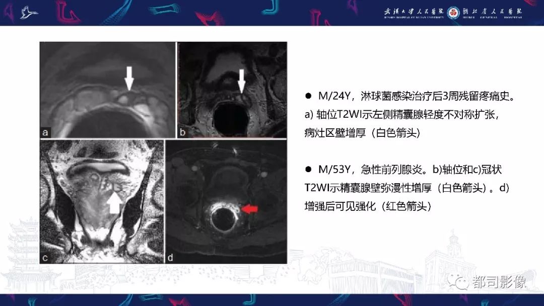精囊腺病变mri表现