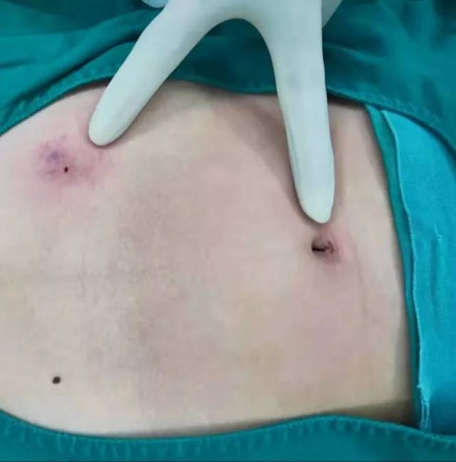 医生手记江门小女孩做了腹部手术居然只有一个隐蔽的疤痕