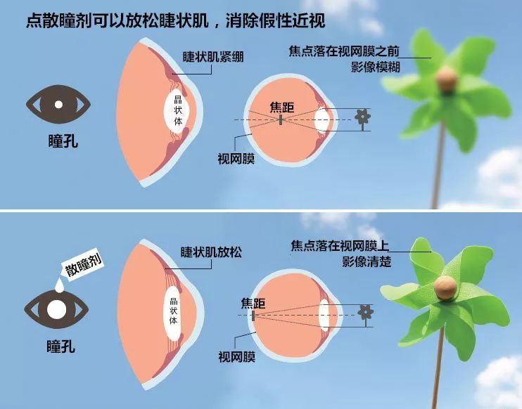 初次配鏡為什麼要散瞳驗光?_眼睛