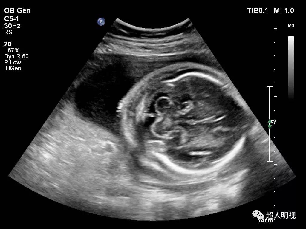 胎儿双足内翻图片