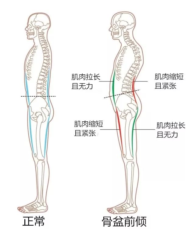 骨盆前傾指骨盆位置發生偏移,向前傾斜的病態現象.