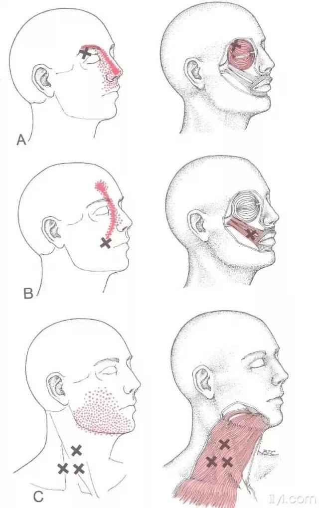 肌筋膜触发点详细图谱建议收藏