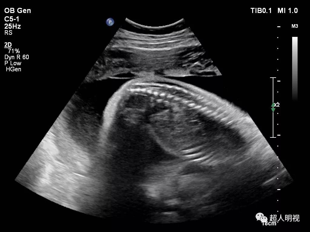 胎儿双足内翻图片